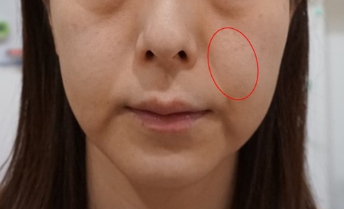 写真あり 頬の脂肪吸引は効果ある 手術を受ける時の考え方