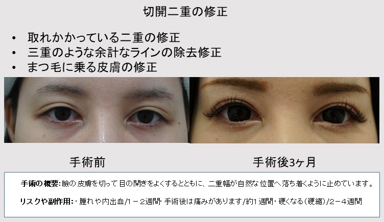 二重全切開法 半永久的に憧れの二重に