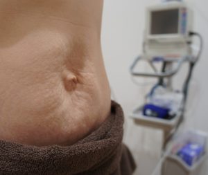 産後のでべその特徴と治療経過の写真