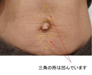 産後のでべその特徴と治療経過の写真