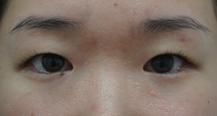 全切開 目頭切開