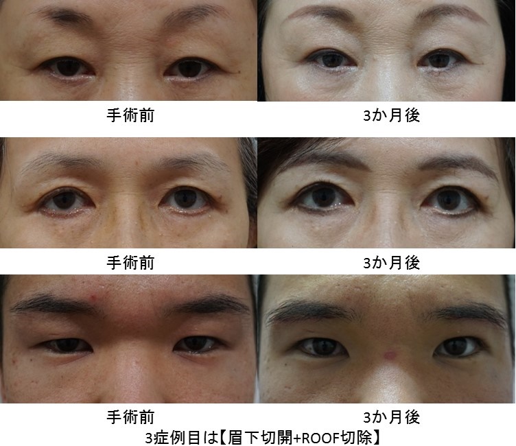 眉下切開 目元のたるみを改善する