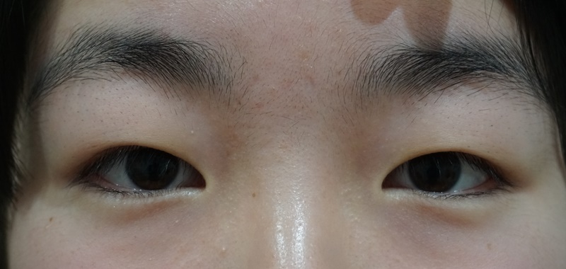 眼瞼下垂 渋谷高野美容医院 渋谷の美容外科クリニック