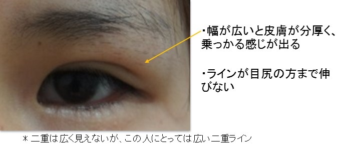 埋没法 二重整形 で腫れにくい自然な手術を進めるための基礎知識