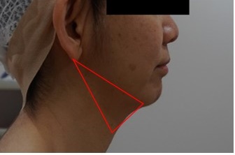 二重あごを解消したい 顎下の脂肪吸引の効果 経過とリスクについて