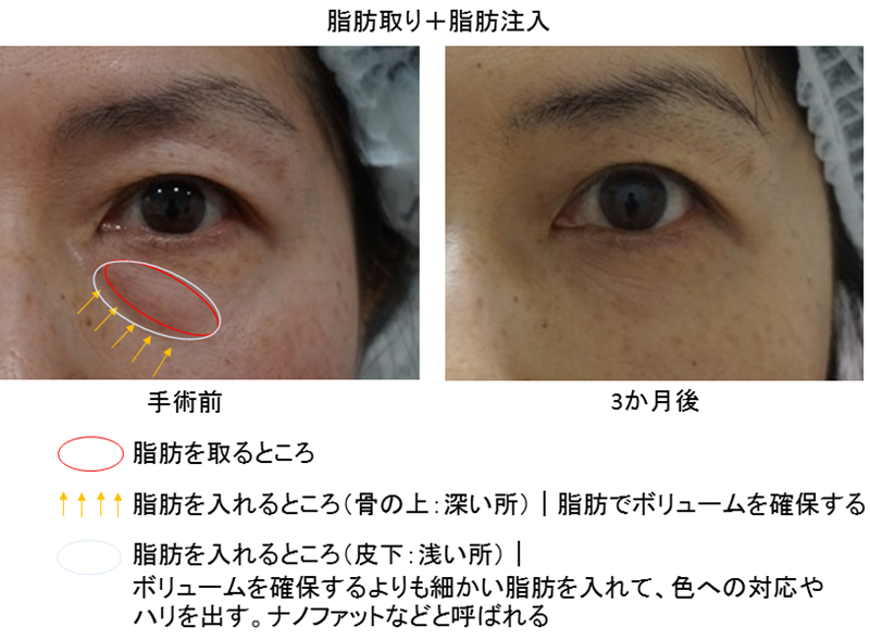 目の下のたるみ取り手術はどれを選ぶ 状態と効果 費用で比較